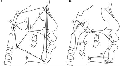 Craniofacial and upper airway morphological characteristics associated with the presence and severity of obstructive sleep apnea in Chinese children